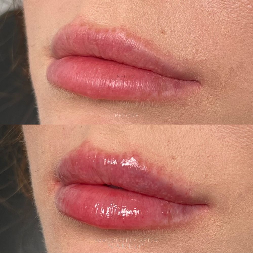 Naked Lips | Lip Filler