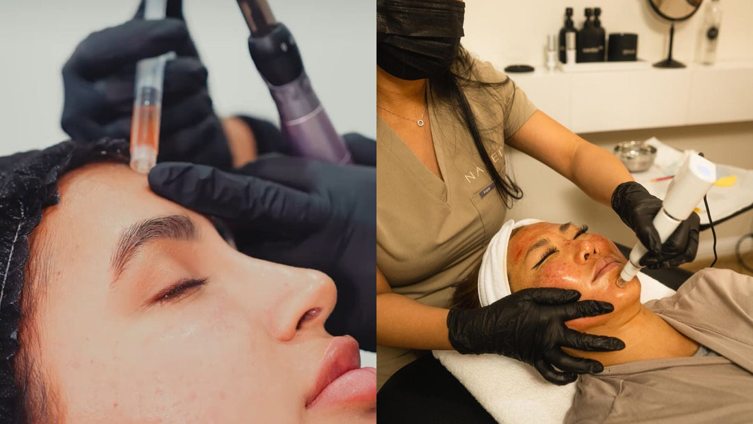 How to Get Rid of Acne Scars: The Best Treatments for Smoother Skin