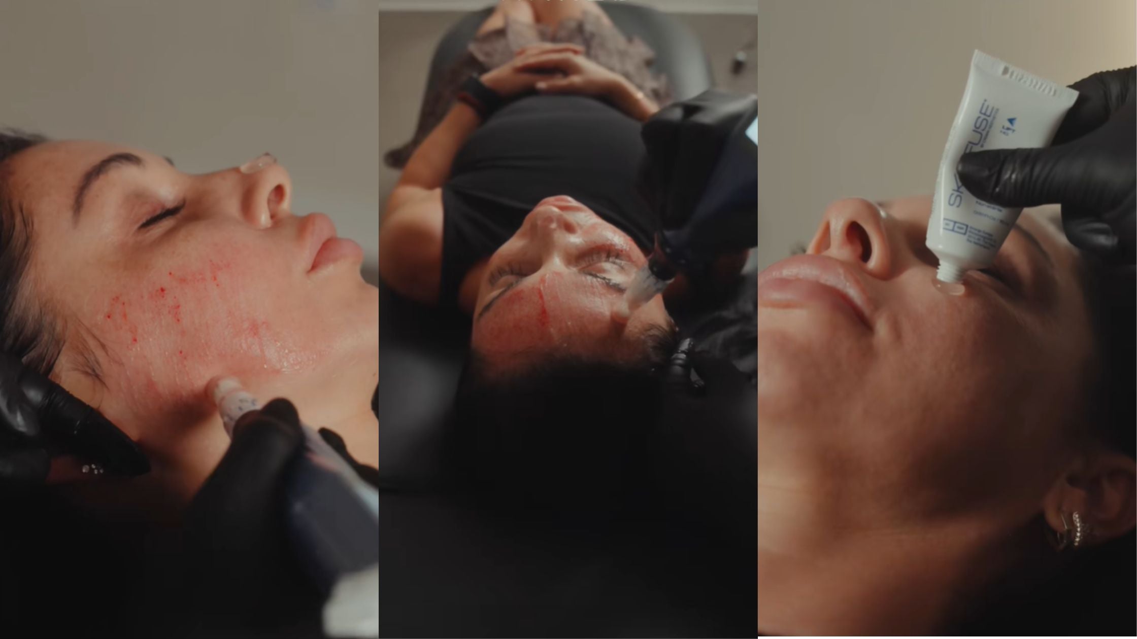 How Microneedling Helps Smooth, Brighten, and Refresh Skin