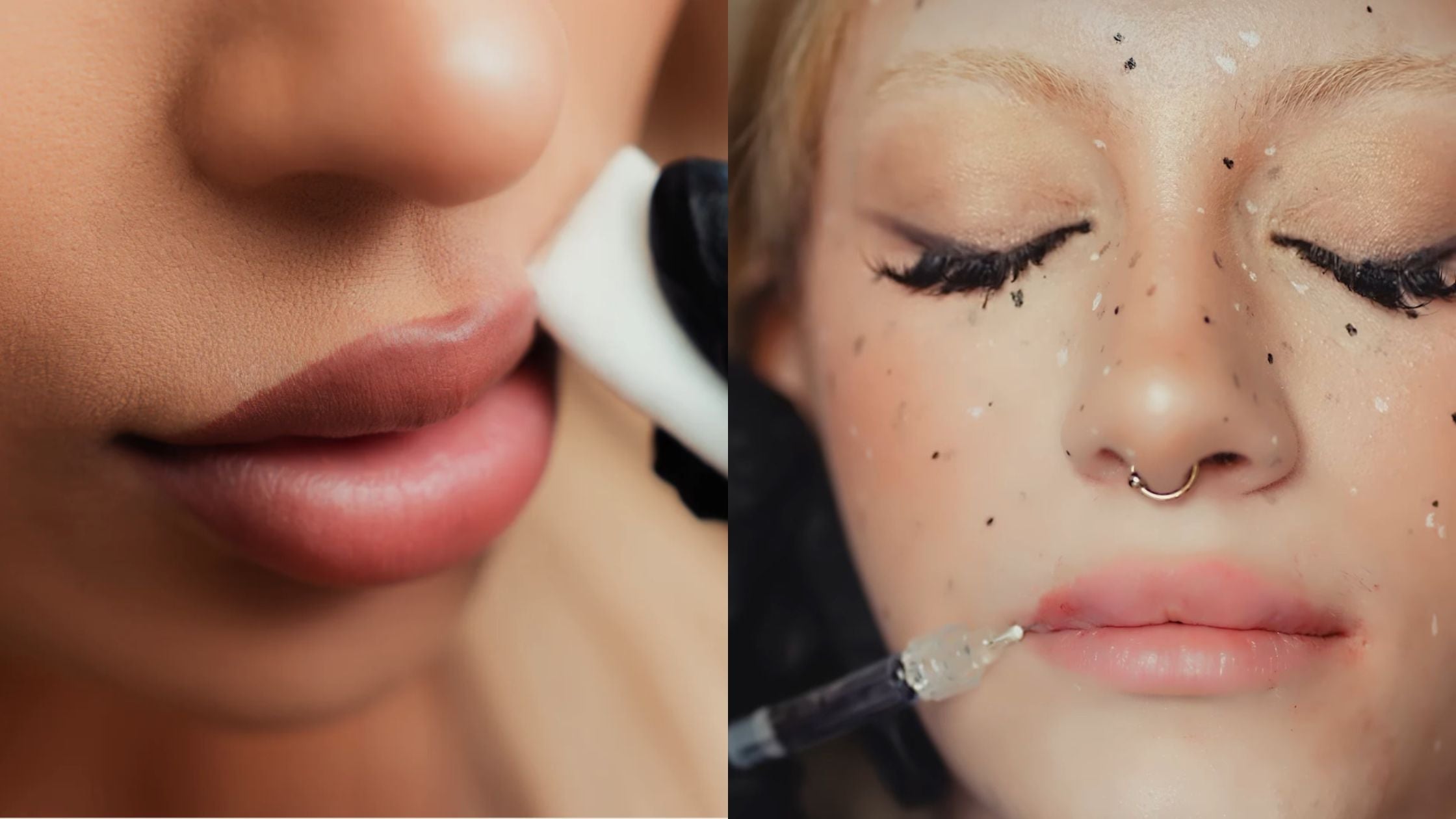 Lip filler trends in 2025