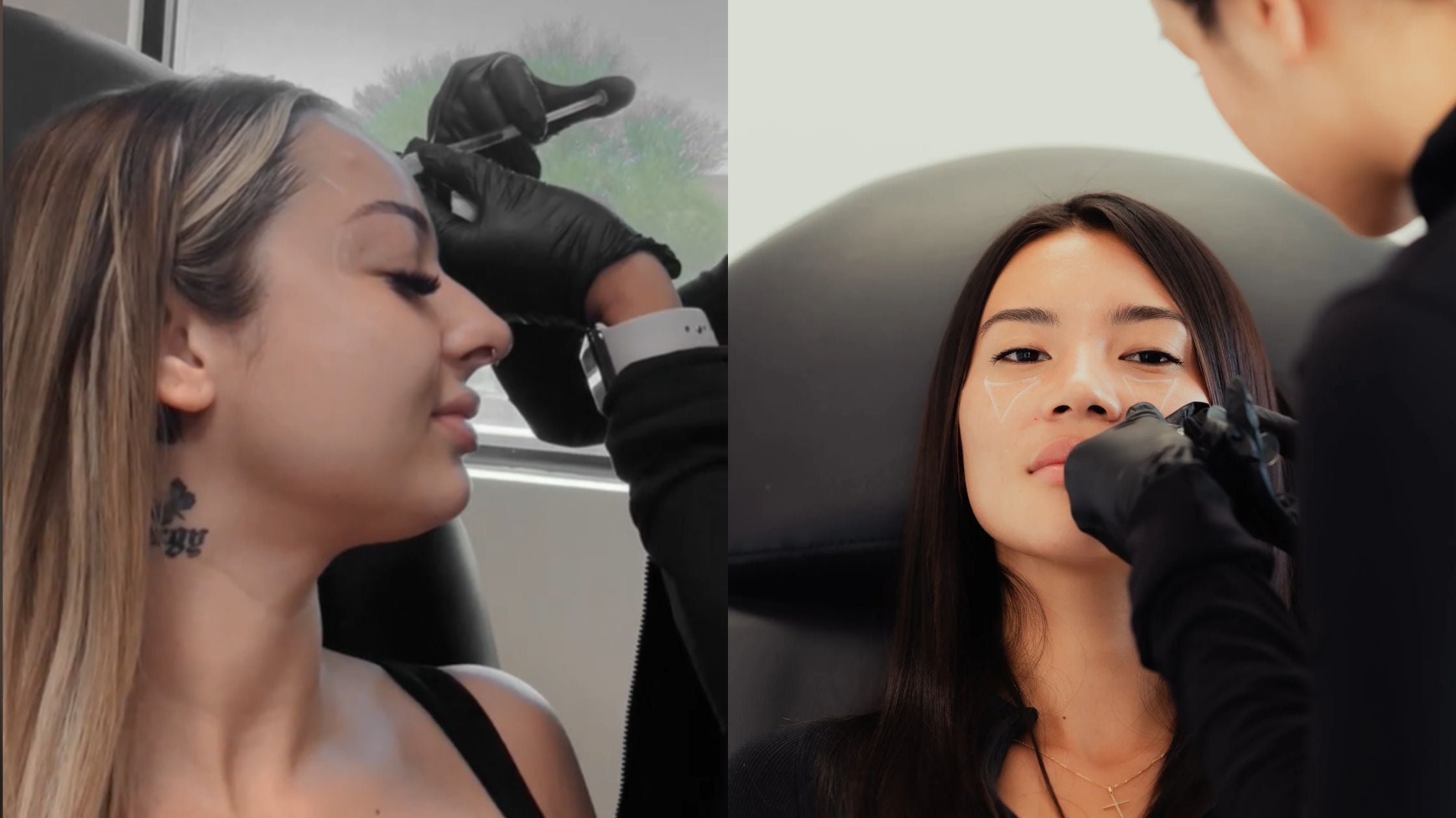 Tox & Filler Treatment in Chino Hills