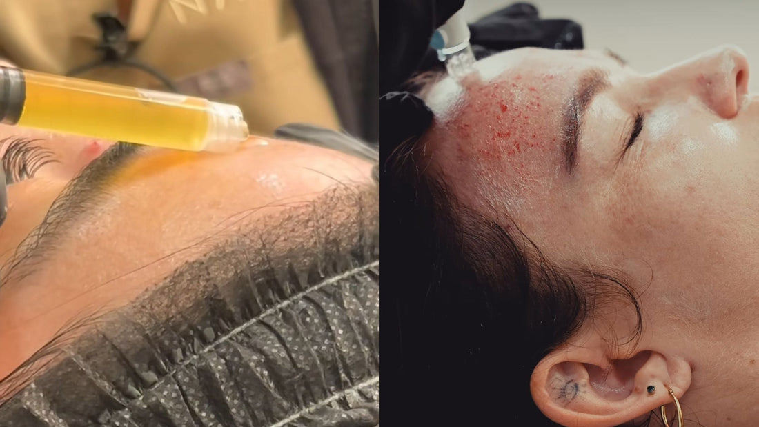 PRF Facial (Vampire Facial) in La Jolla