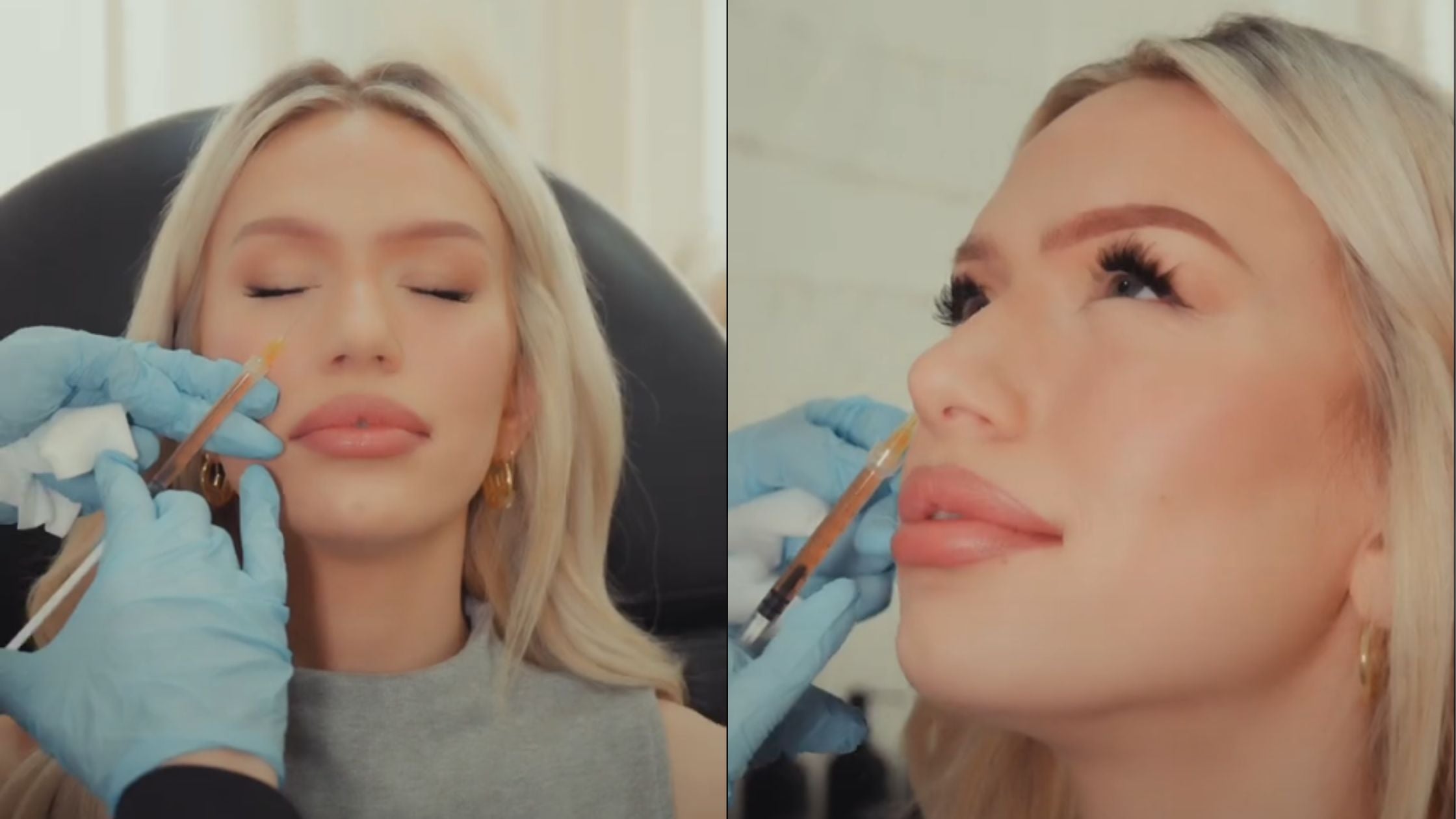 Undereye Filler in California and Arizona at NakedMD