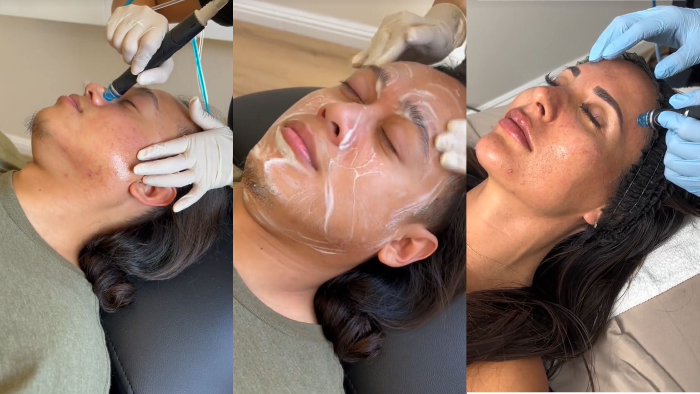 Affordable Hydrafacial in California and Arizona with NakedMD