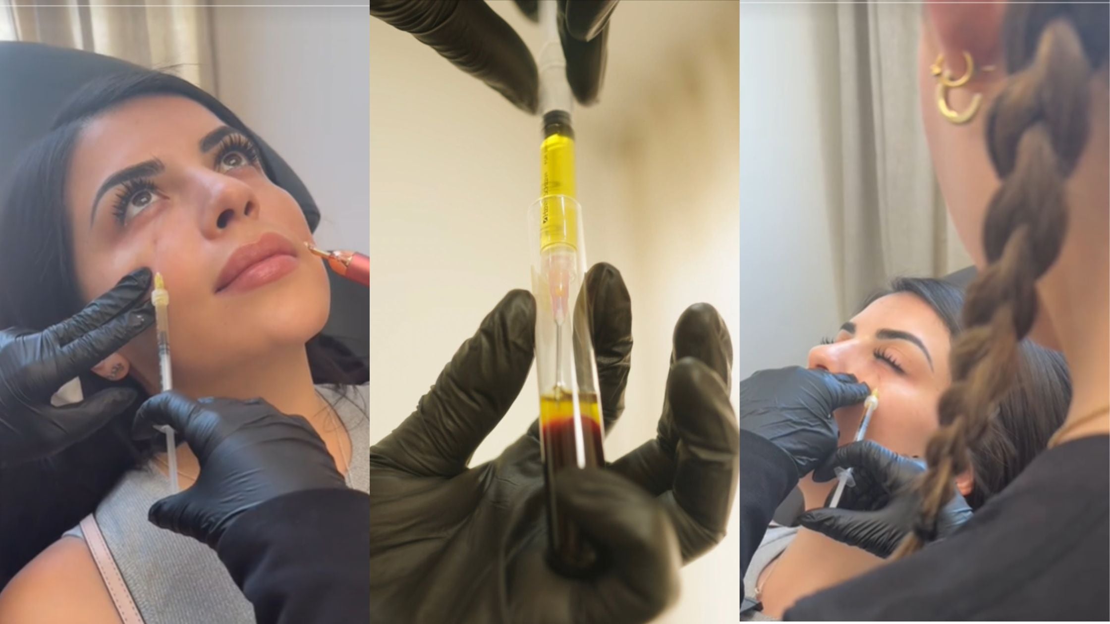 PRF (Platelet Rich Fibrin) Injection in California and Arizona