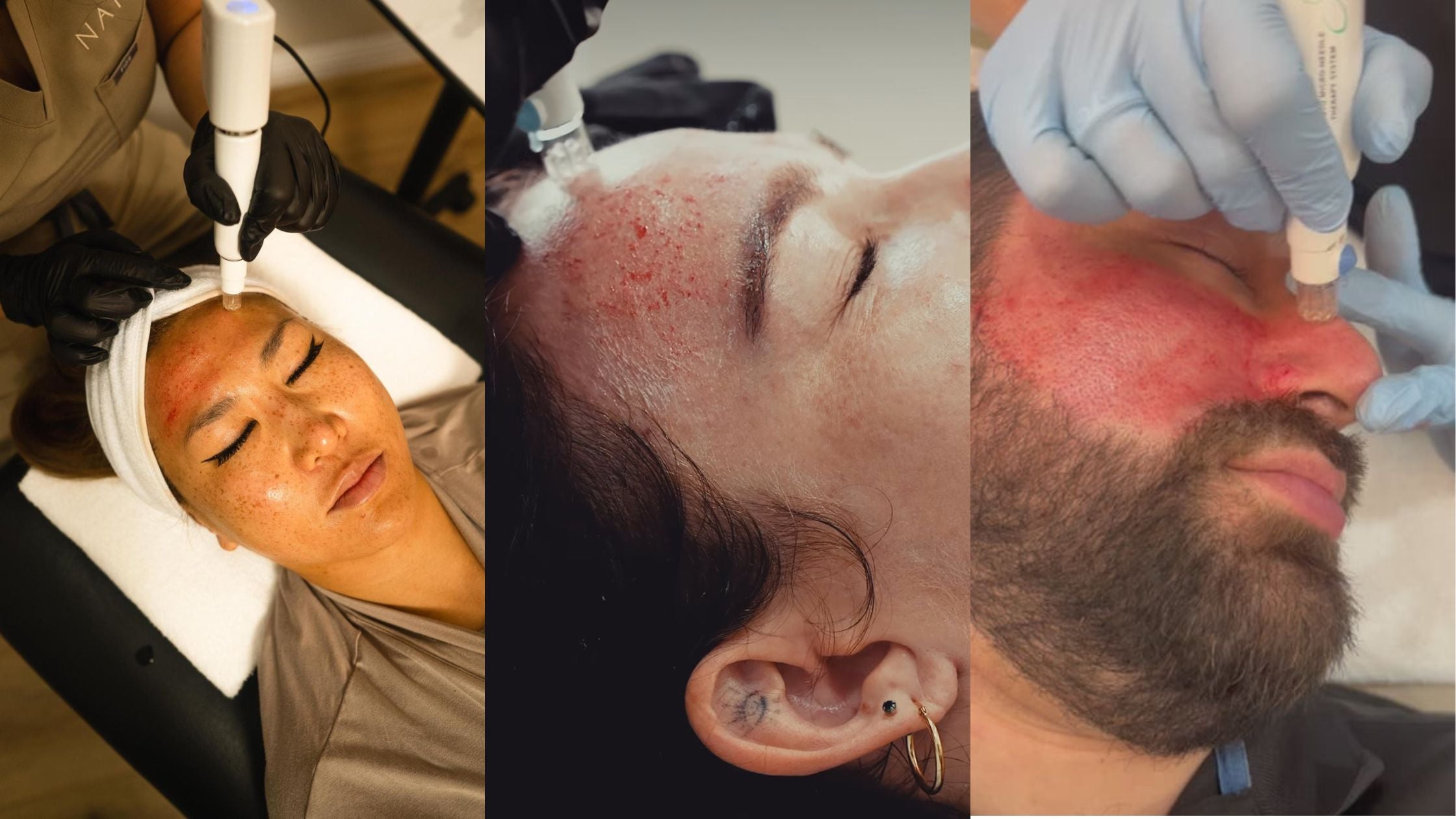 Affordable microneedling at NakedMD in CA and AZ
