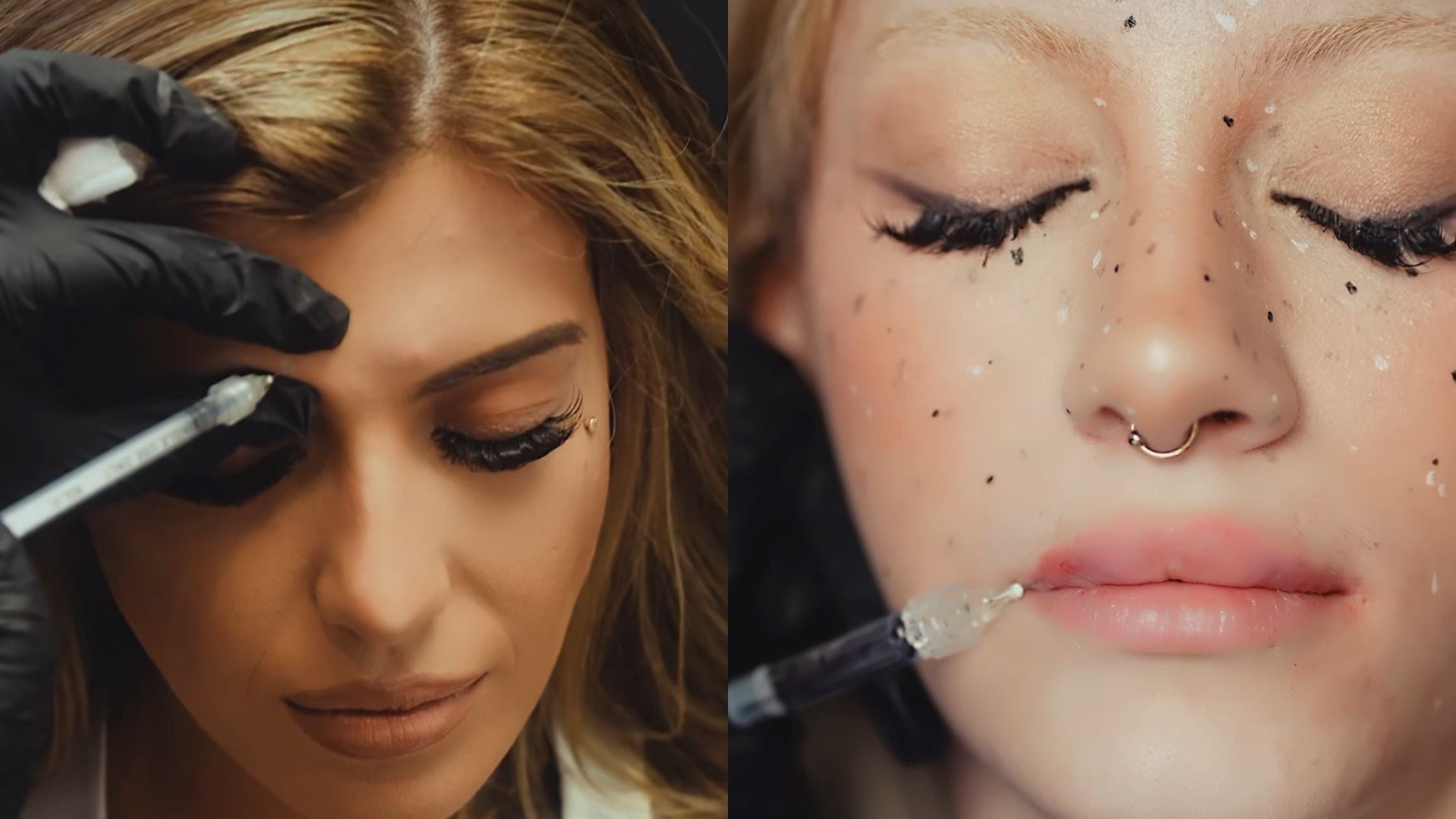 TOX Injection & Dermal Fillers by NakedMD