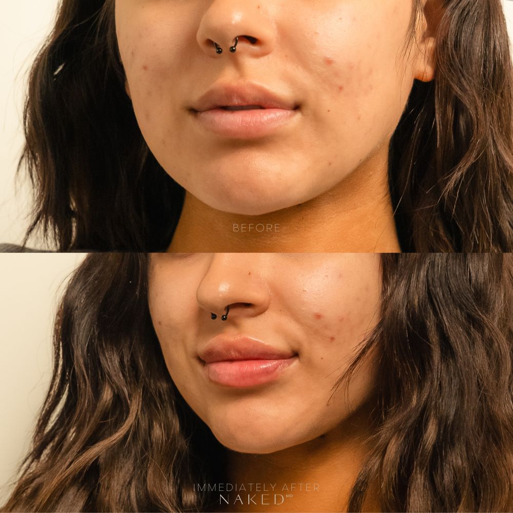 First Time Getting Lip Filler? What to Know Before Your Appointment