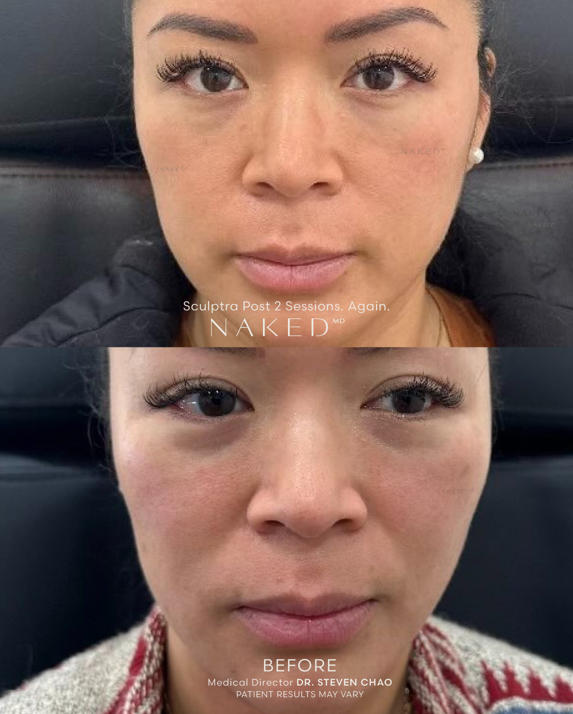 Sculptra® Filler