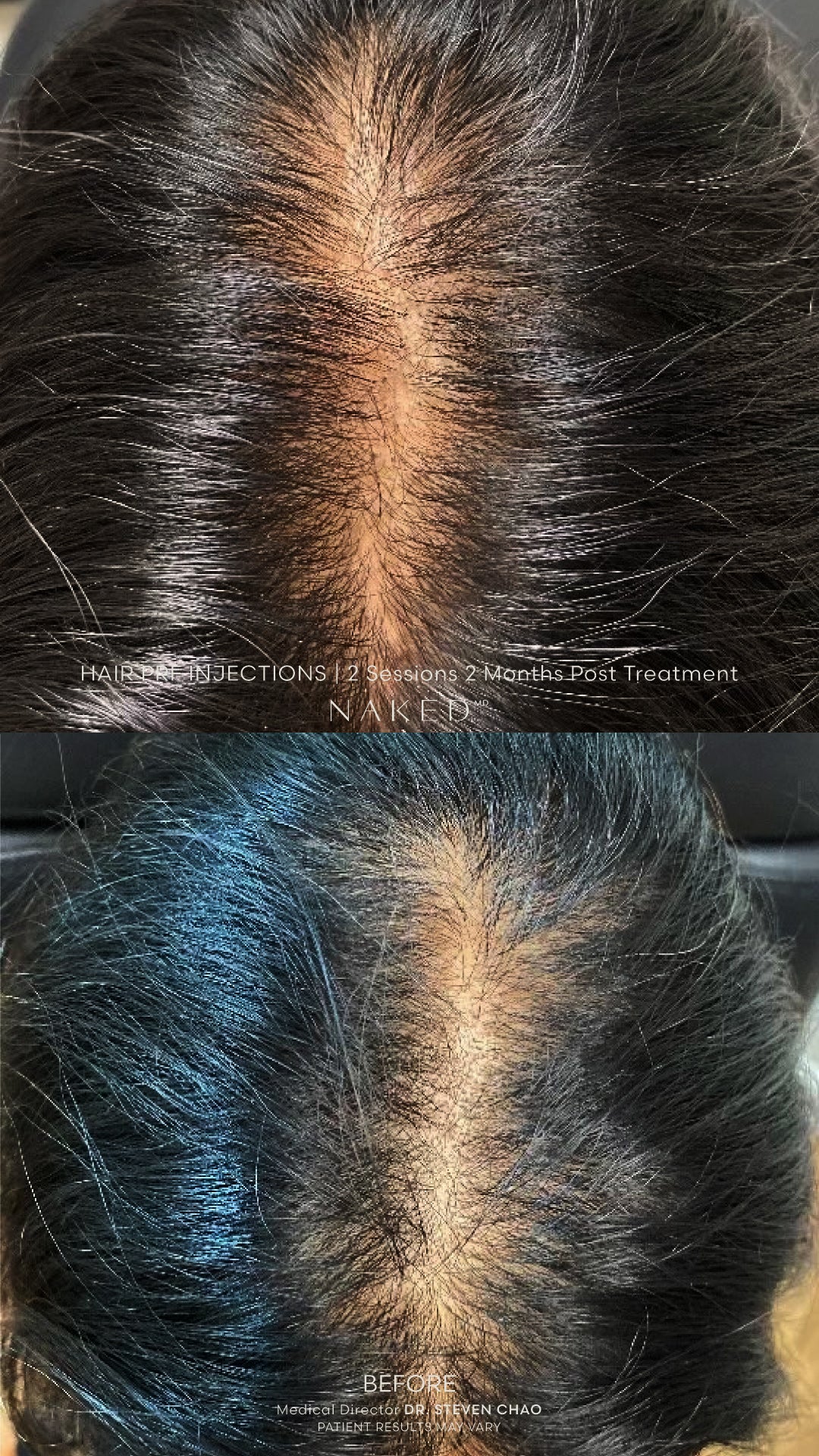 PRF Treatment | Under Eye, Microneedling in California & Arizona ...