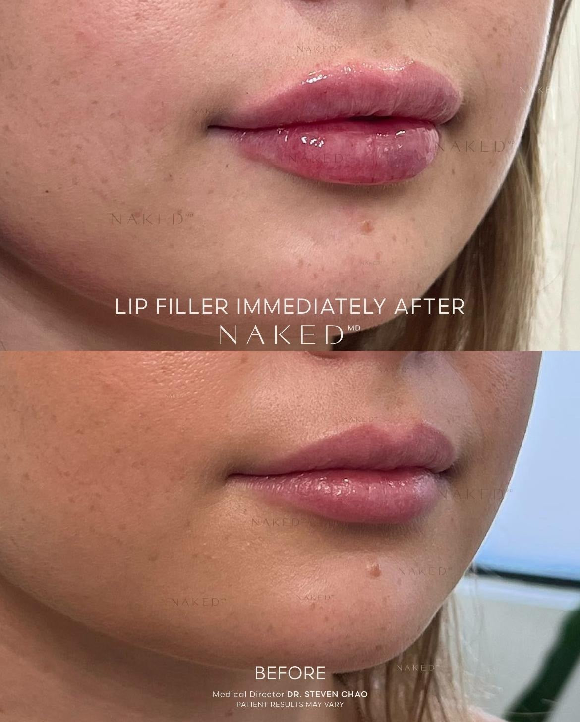 Naked Lips | Lip Filler