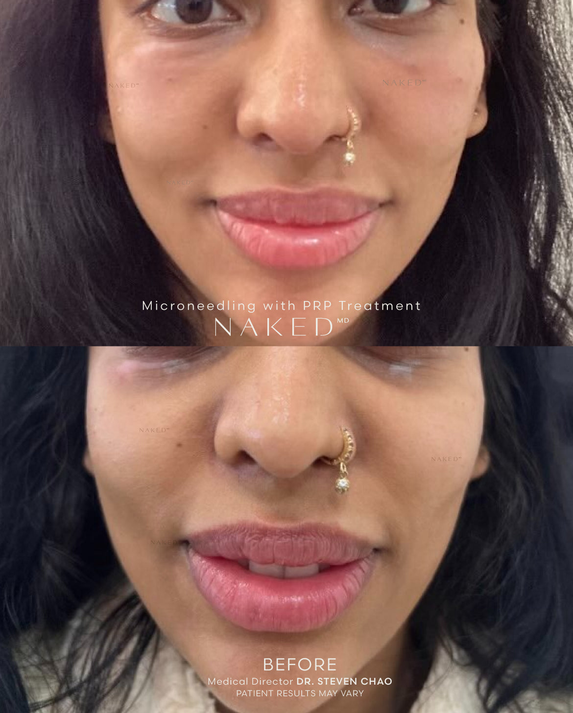 Microneedling + Options