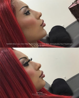 Naked Nose | Non-Surgical Nose Job (NSNJ)