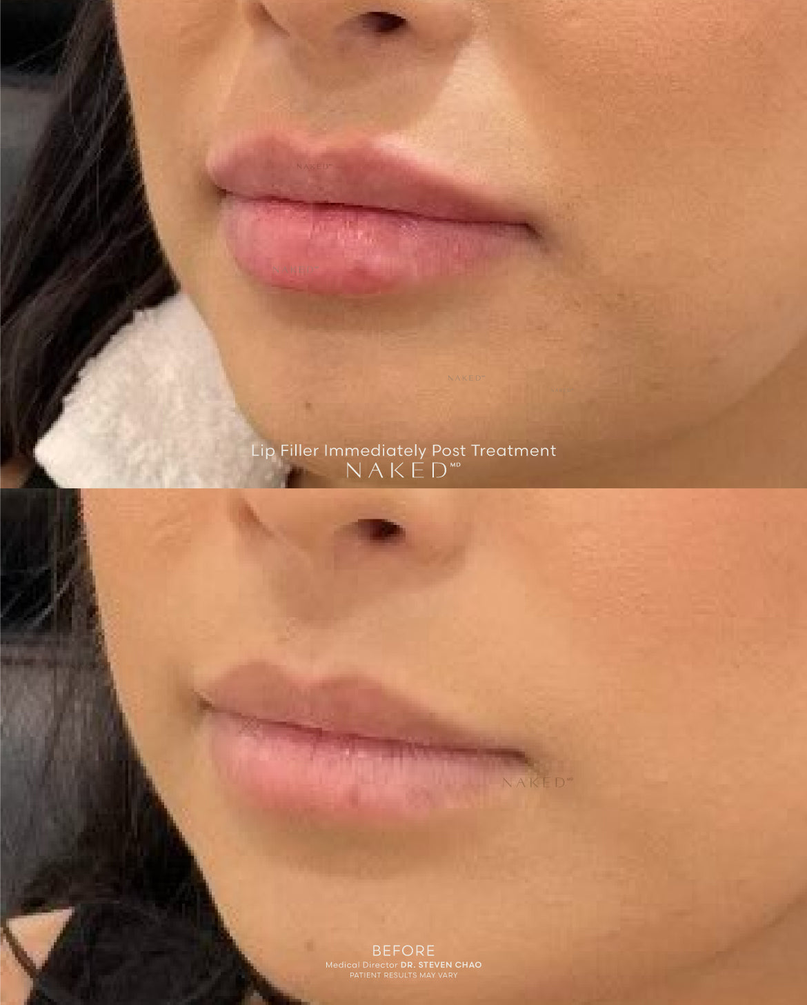 Naked Lips | Lip Filler