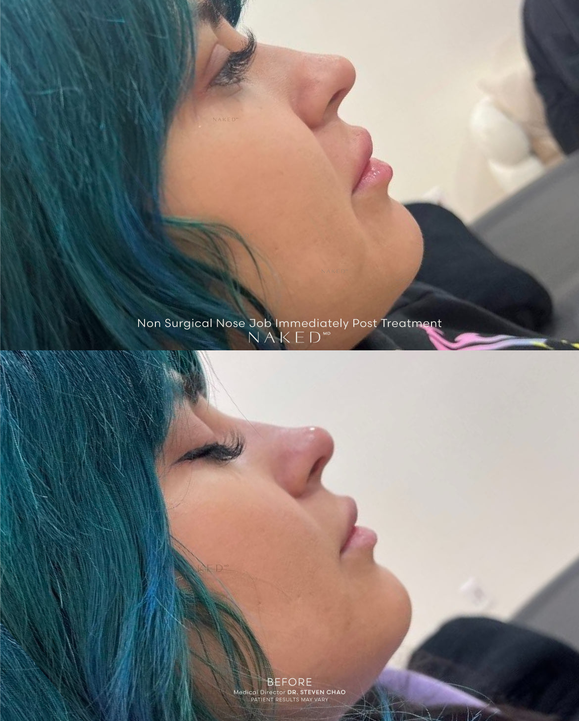 Naked Nose® | Non-Surgical Nose Job (NSNJ)