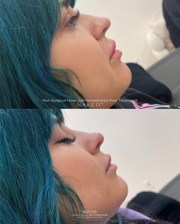 Naked Nose | Non-Surgical Nose Job (NSNJ)