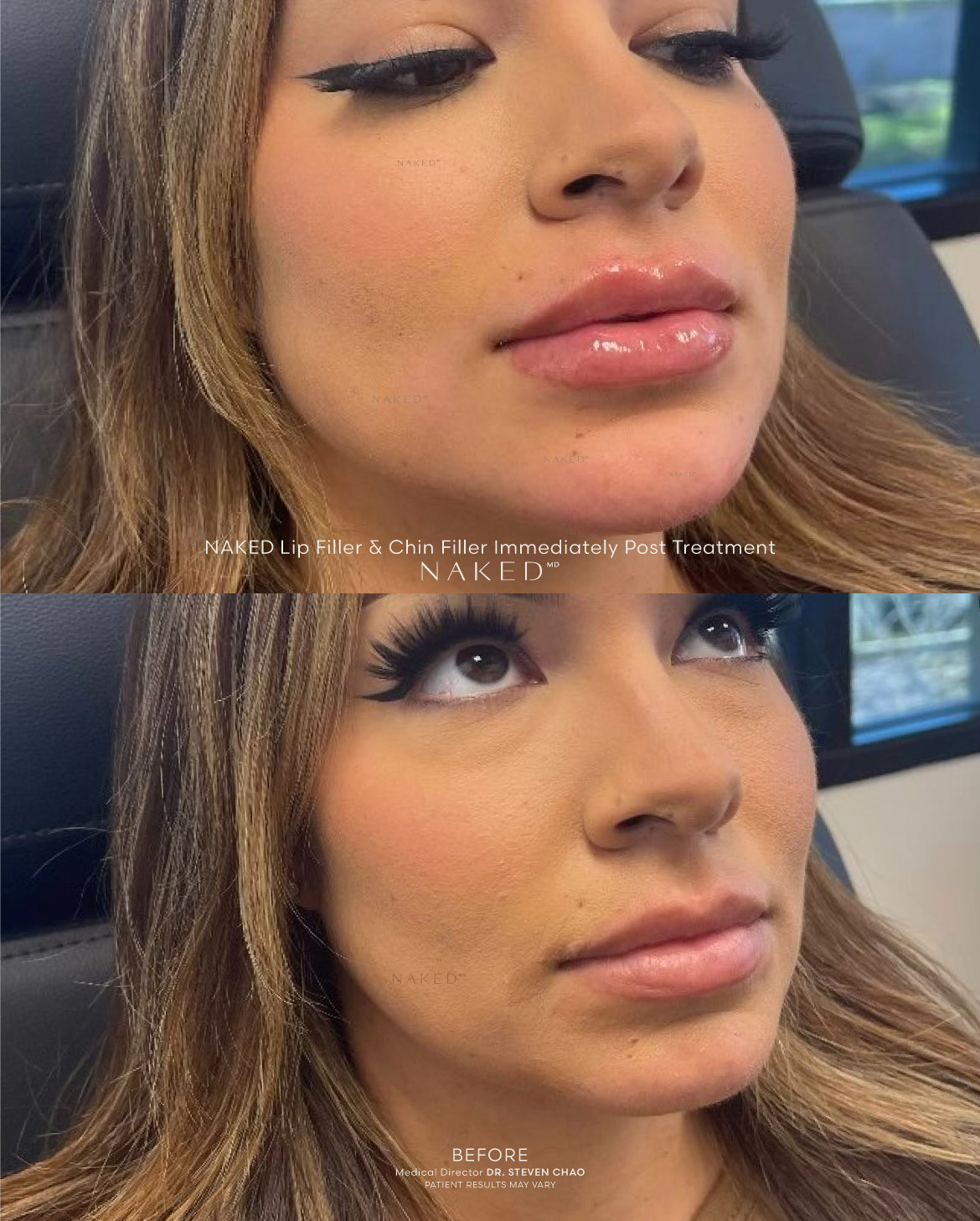 Naked Lips | Lip Filler