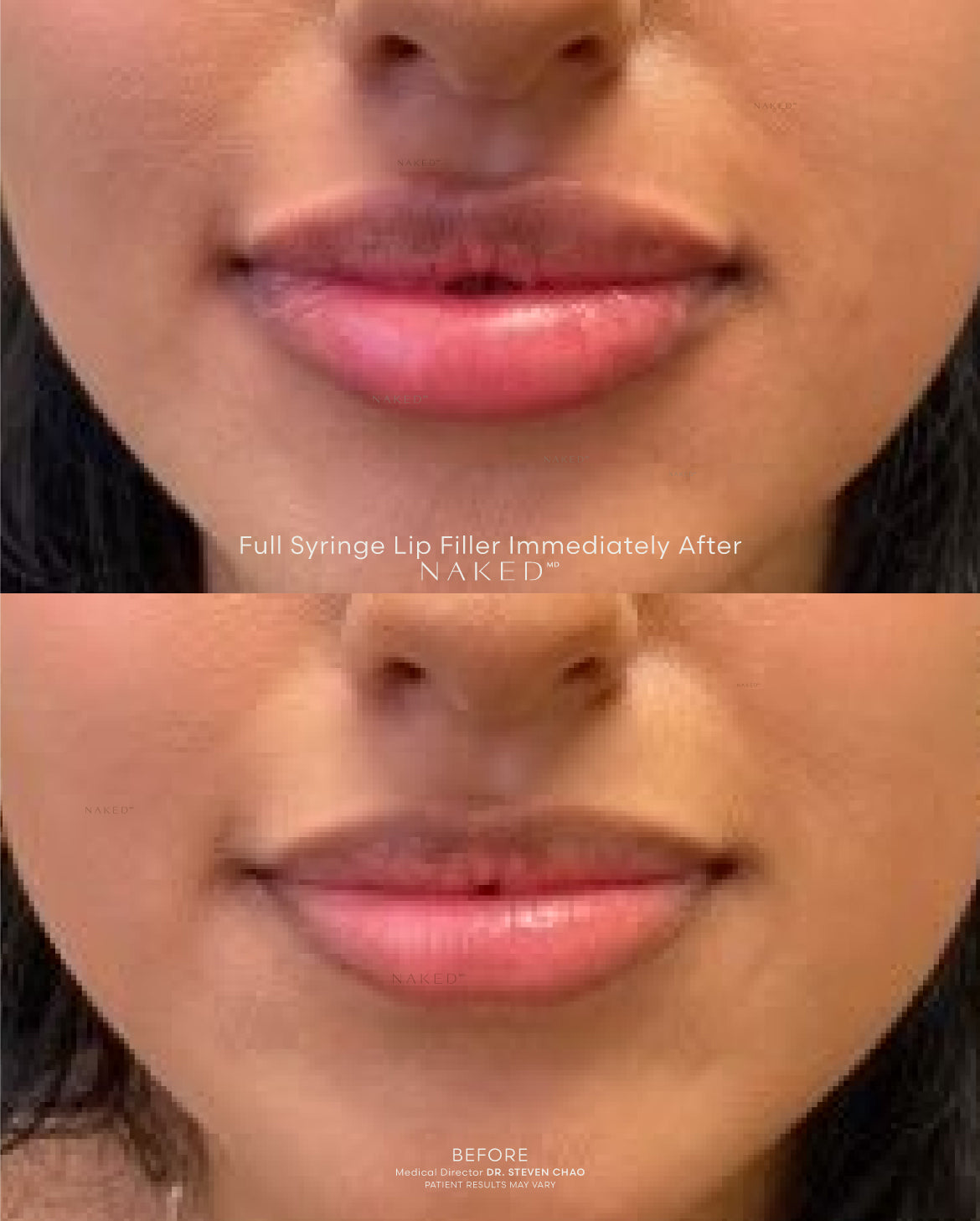 Naked Lips | Lip Filler