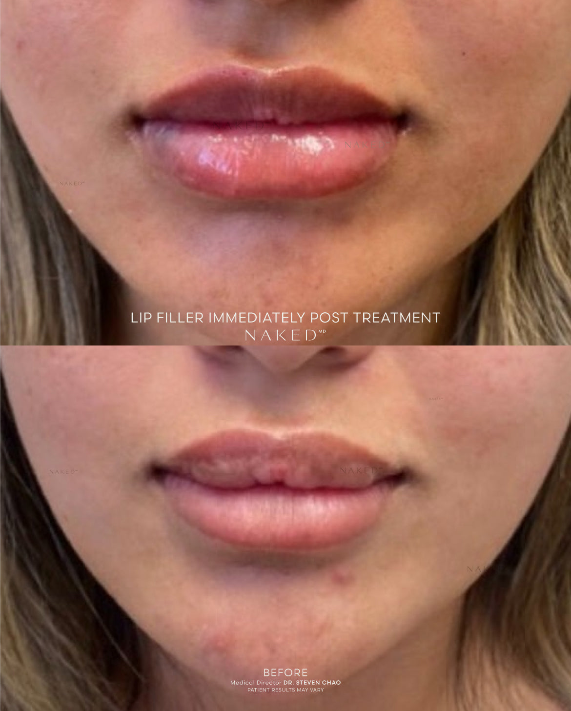 Naked Lips | Lip Filler