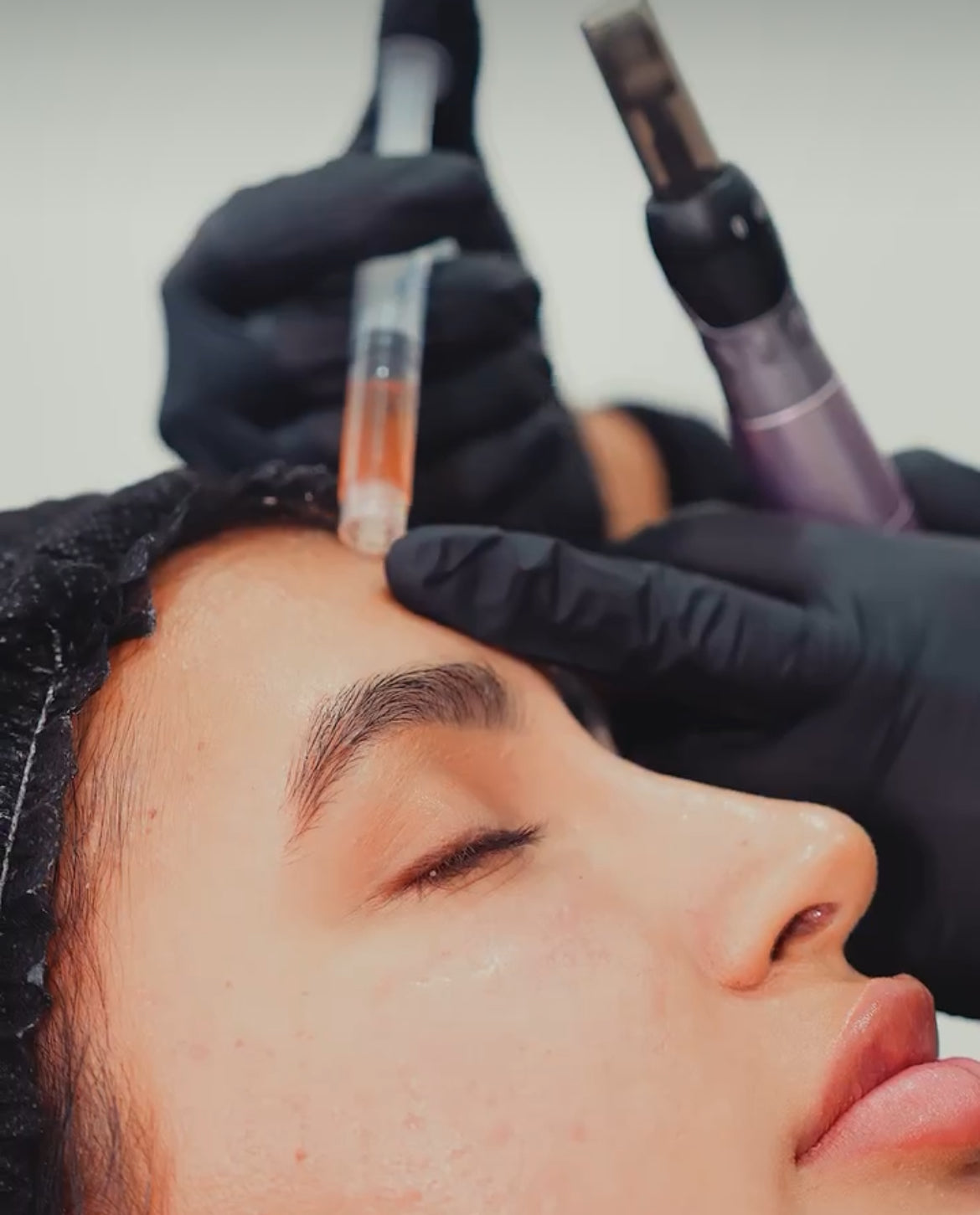 PRF Microneedling (Platelet Rich Fibrin) "Vampire Facial"