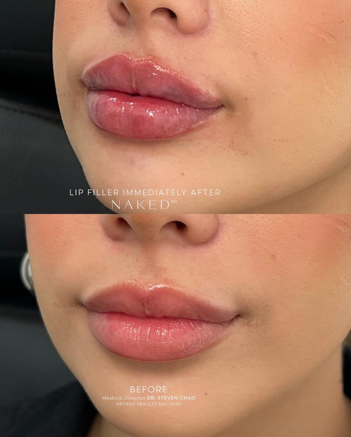 Naked Lips | Lip Filler