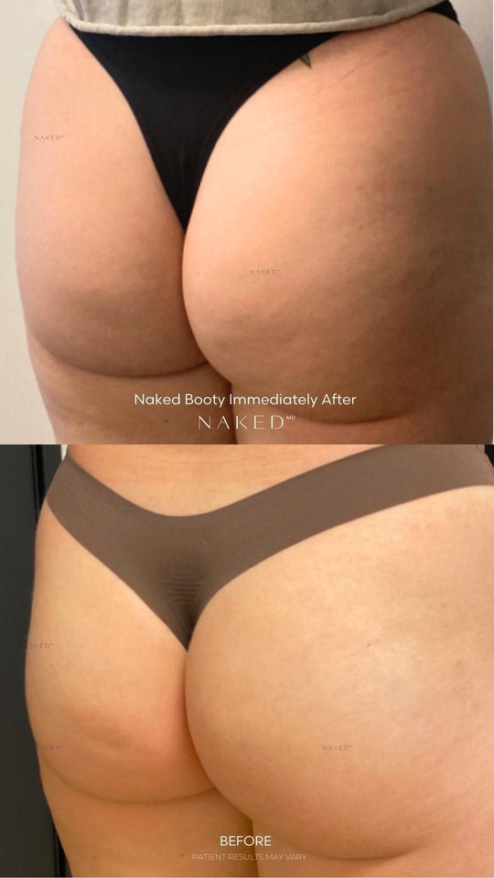 Non Surgical BBL | Butt Lift in California and Arizona – NAKEDMD Medspa