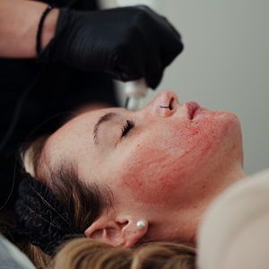 SkinPen®  Microneedling