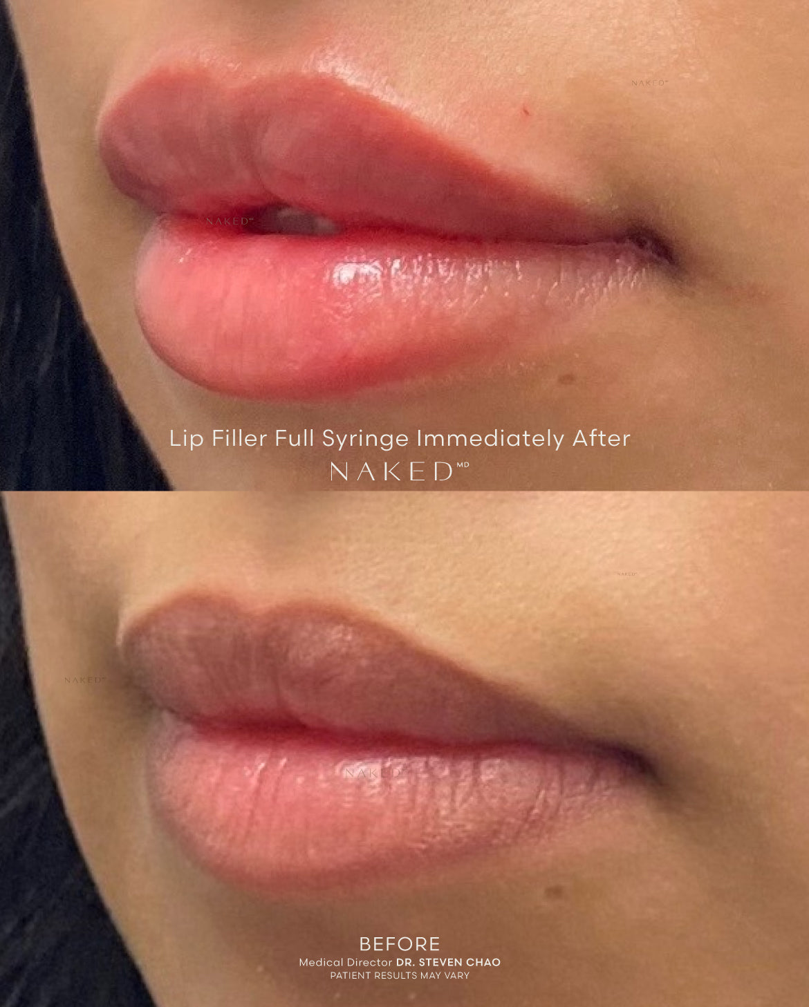 Naked Lips | Lip Filler