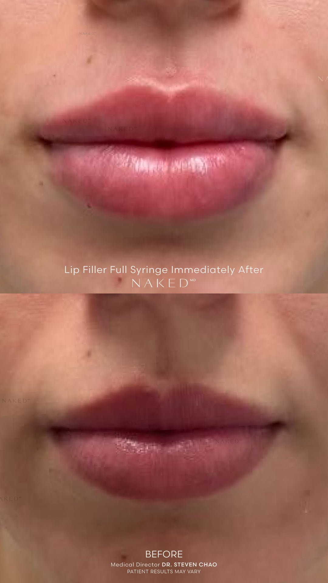 Naked Lips | Lip Filler