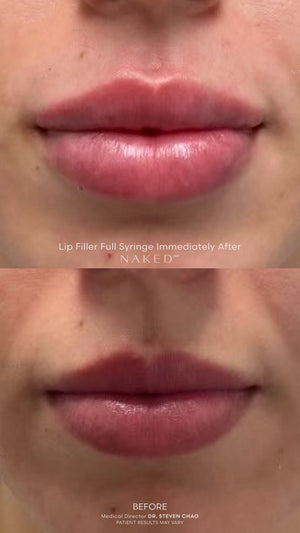 Naked Lips | Lip Filler
