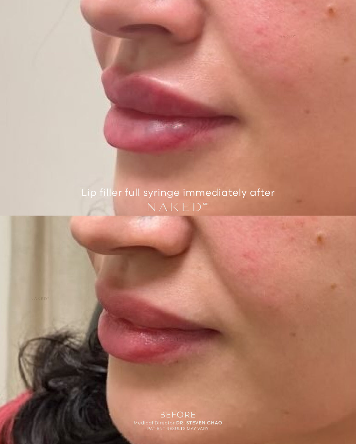 Naked Lips | Lip Filler