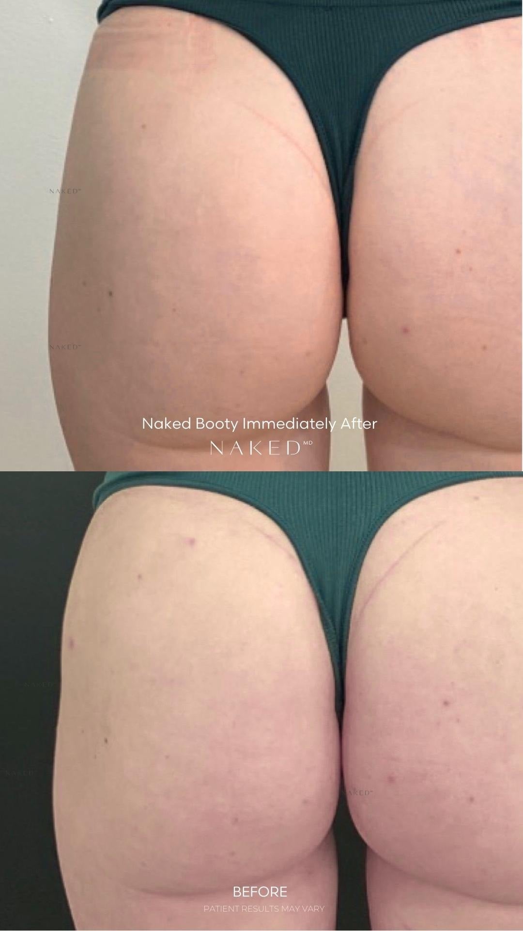 Naked Booty® | Non-Surgical Brazilian Butt Lift (BBL)