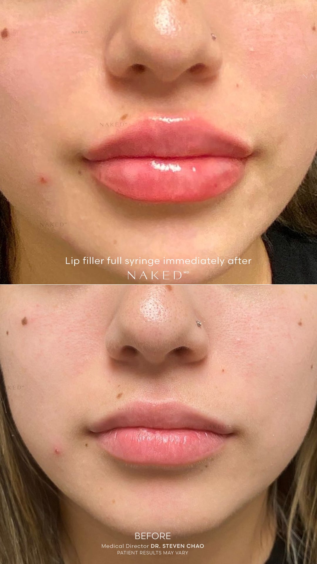 Naked Lips | Lip Filler