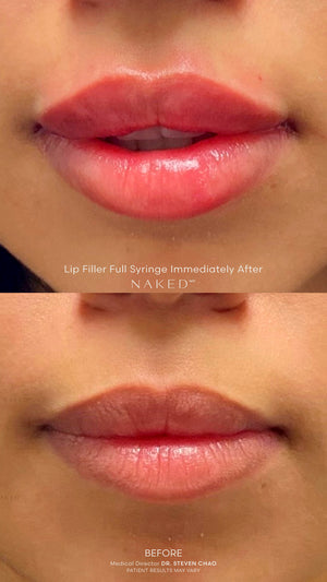 Naked Lips | Lip Filler