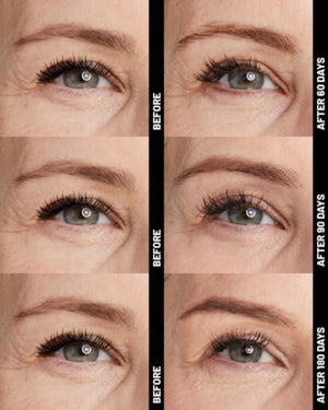 Ultherapy® | Non-Surgical Ultrasound Therapy