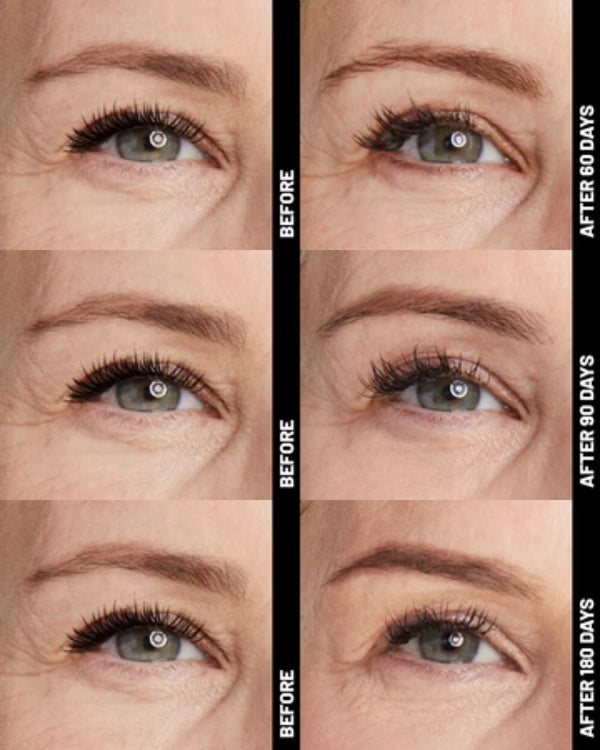 Ultherapy® | Non-Surgical Ultrasound Therapy