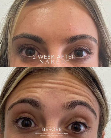 Reduce Forehead Lines with TOX Injections – NAKEDMD Medspa