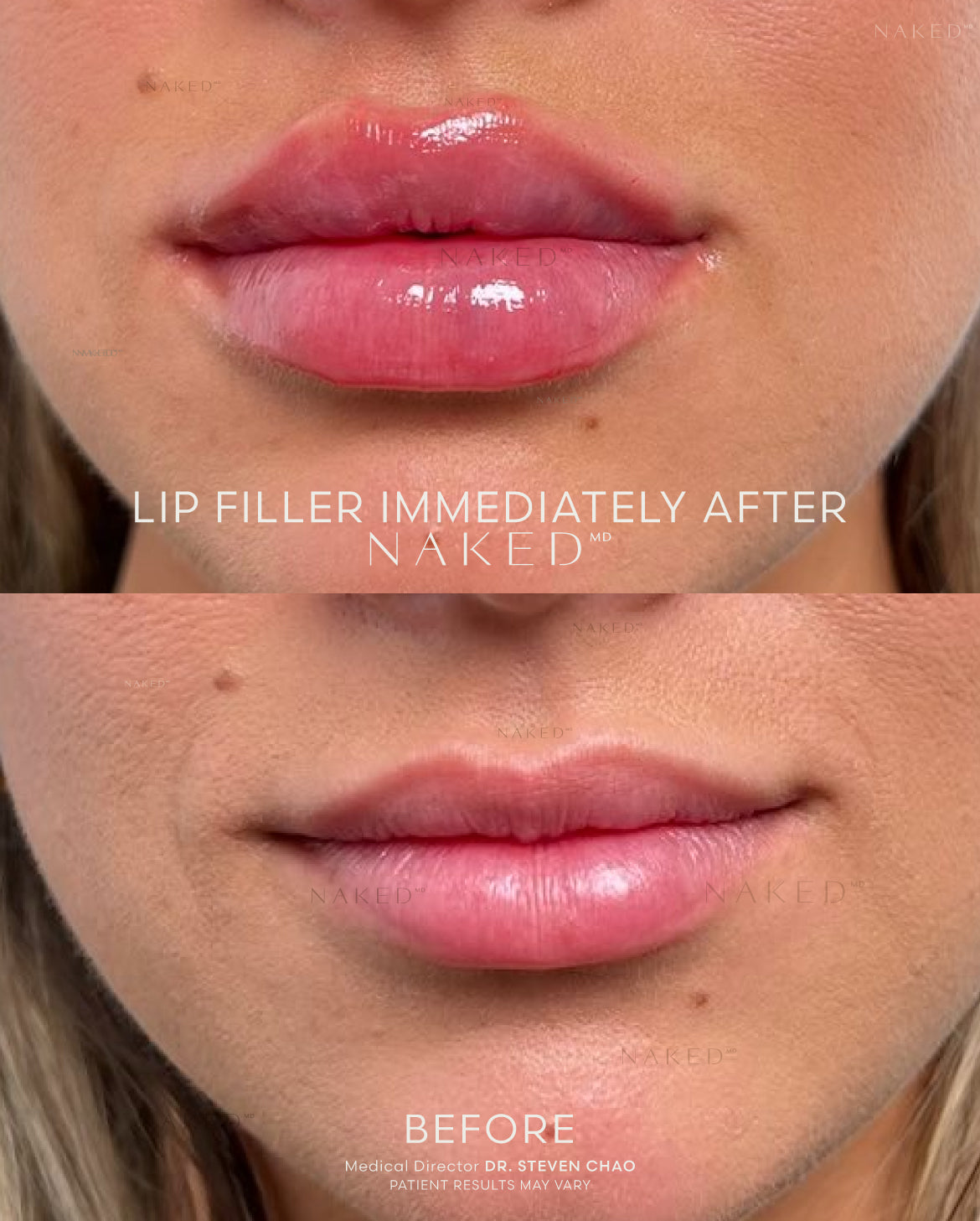 Naked Lips | Lip Filler