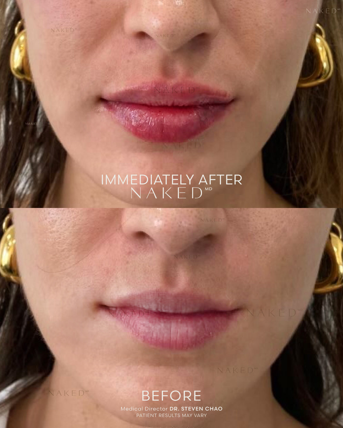 Naked Lips | Lip Filler