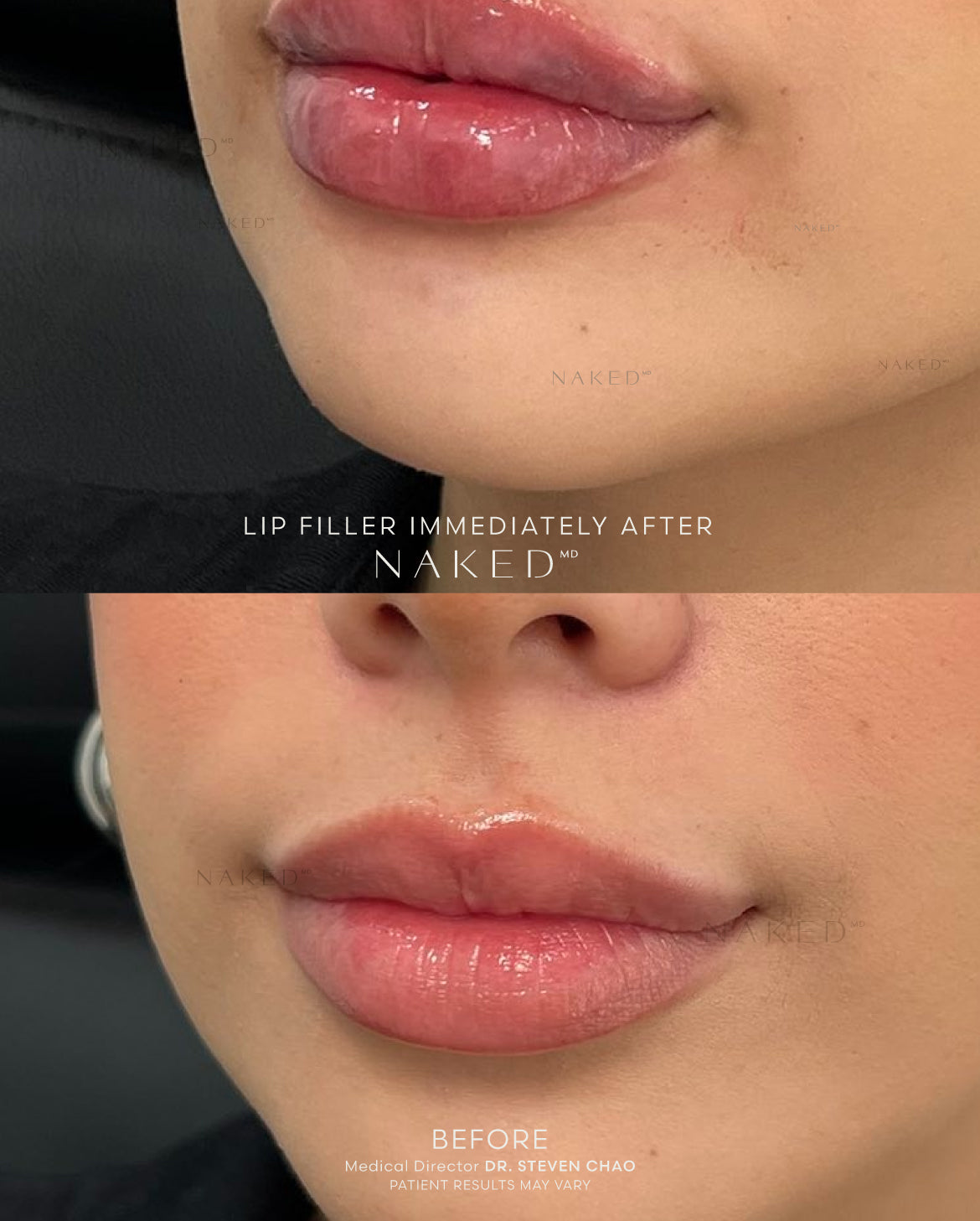 Naked Lips | Lip Filler