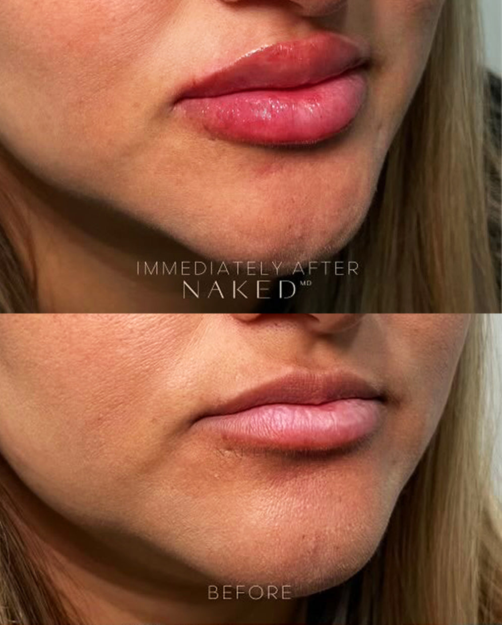 Naked Lips | Lip Filler