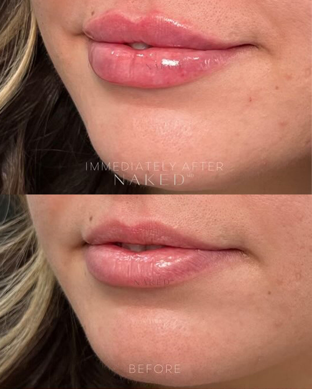 Naked Lips | Lip Filler