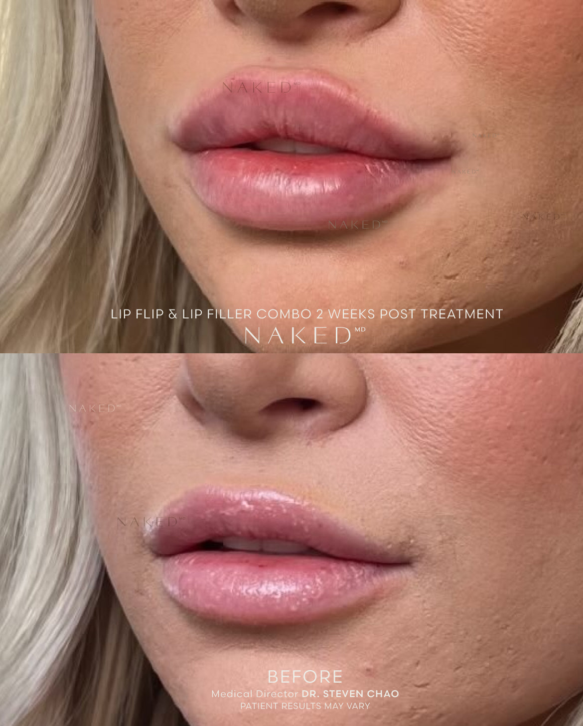 Naked Lips | Lip Filler