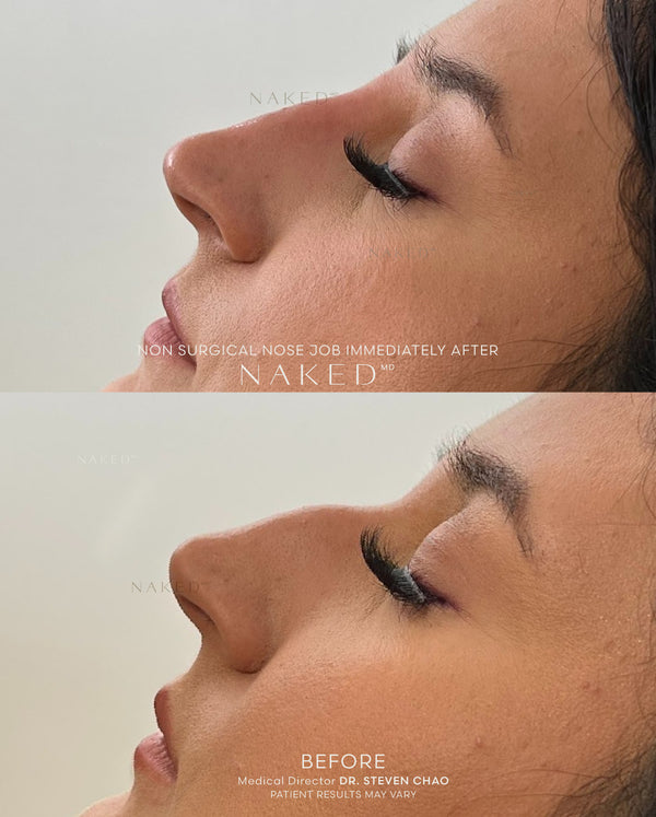 Naked Nose | Non-Surgical Nose Job (NSNJ)