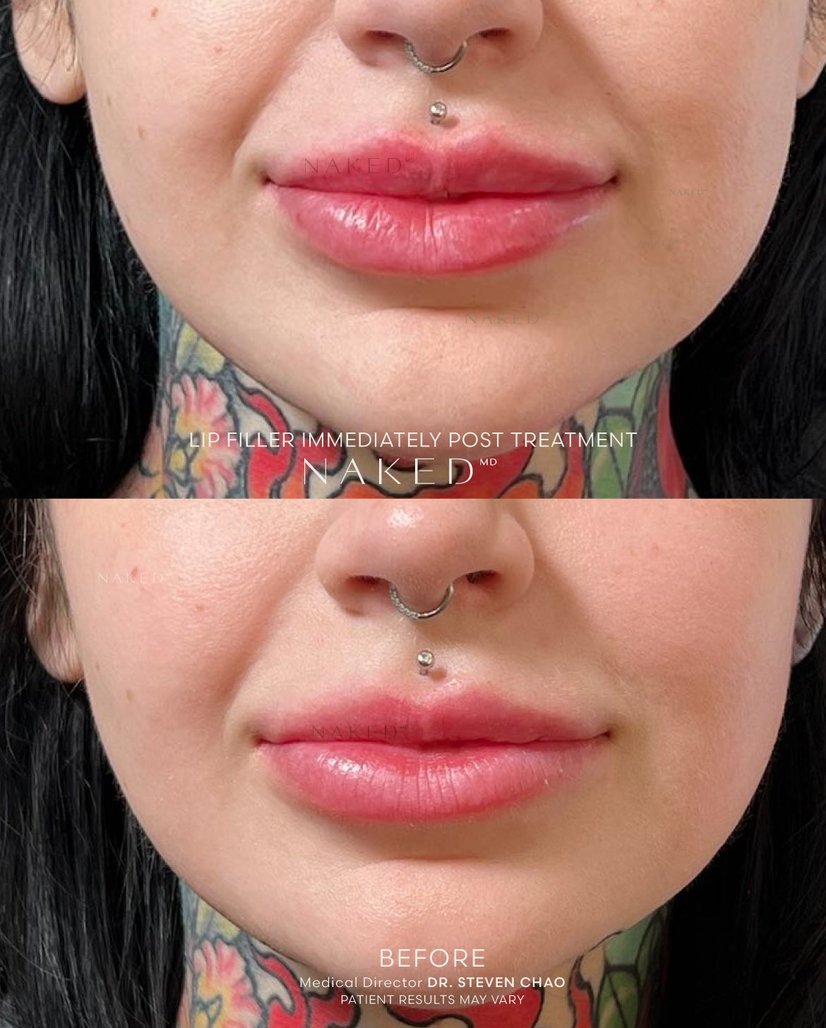 Naked Lips | Lip Filler