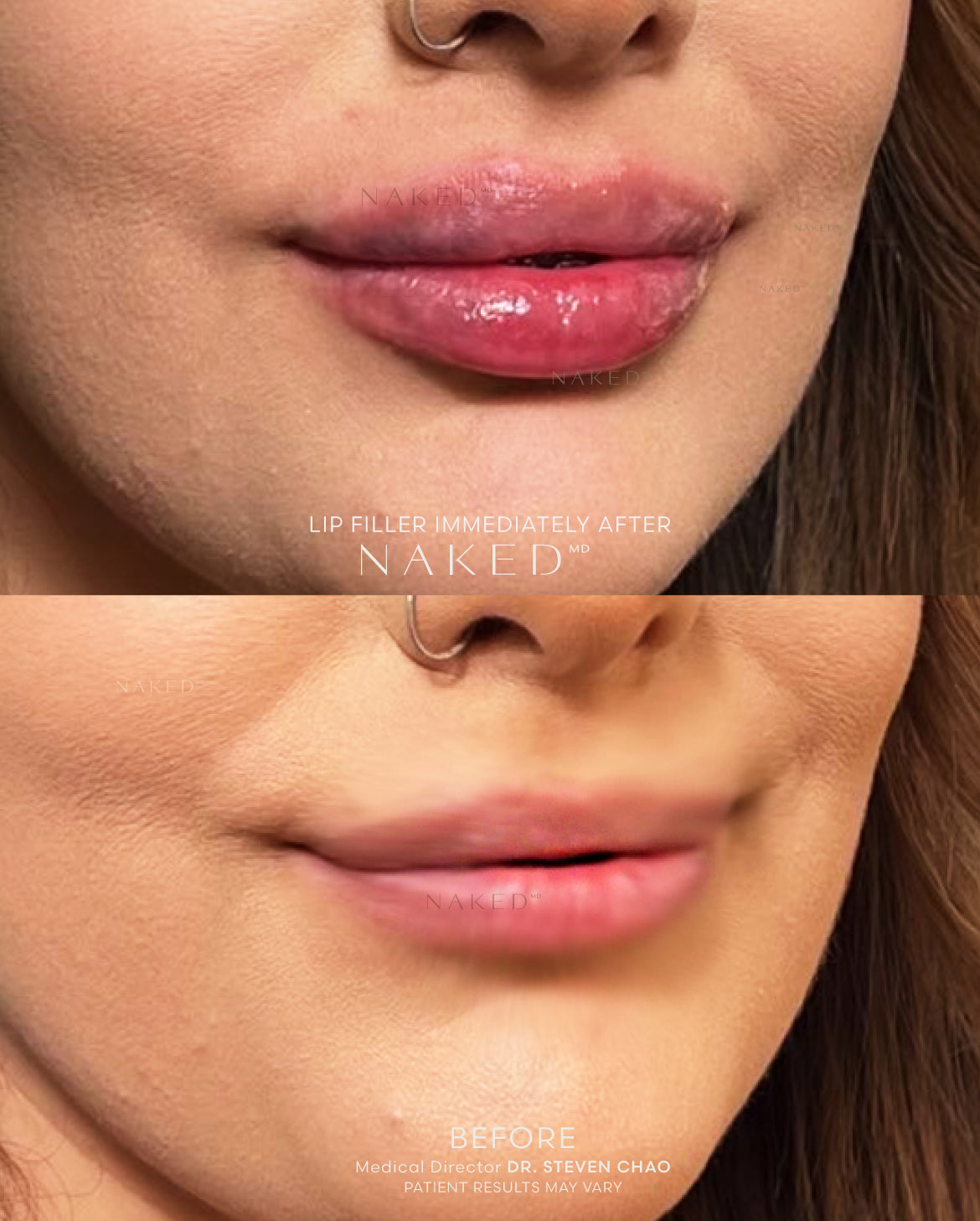 Naked Lips | Lip Filler