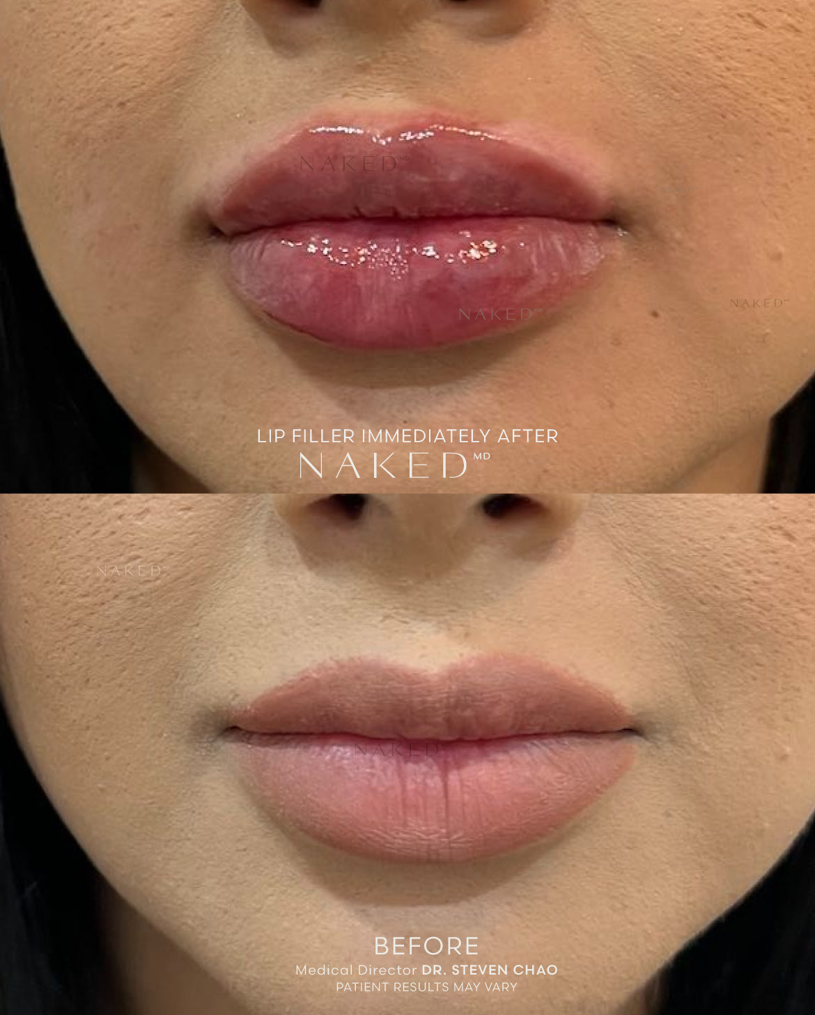 Naked Lips | Lip Filler