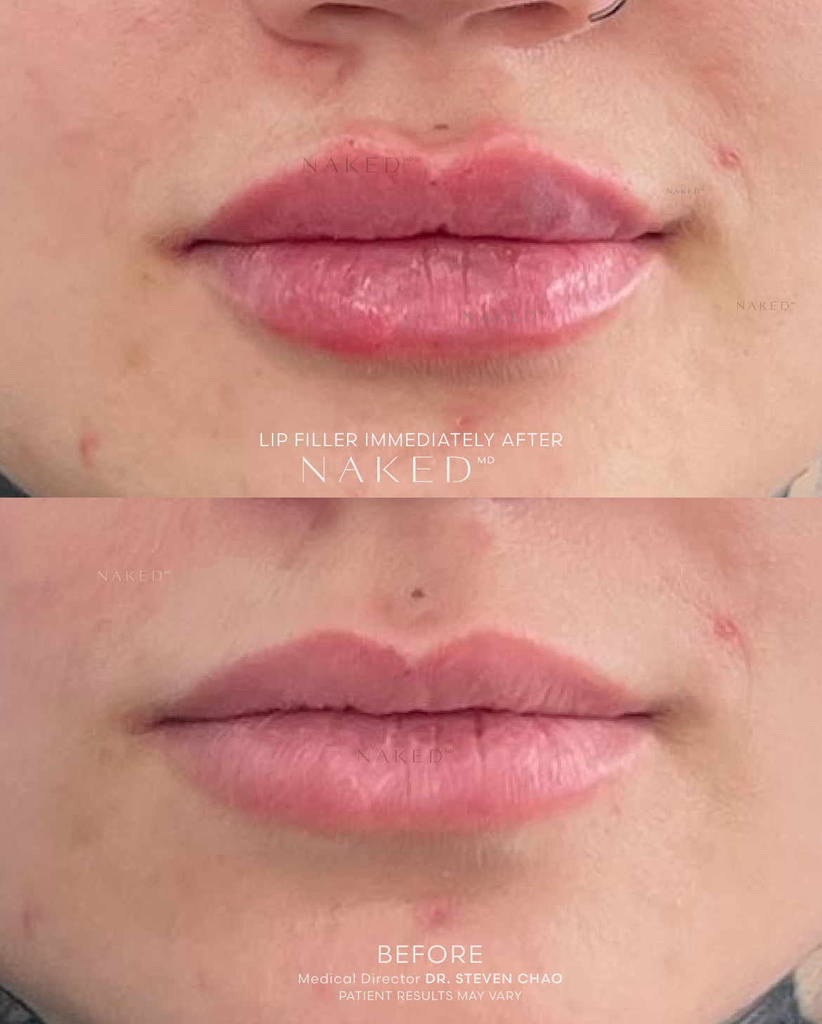 Naked Lips | Lip Filler