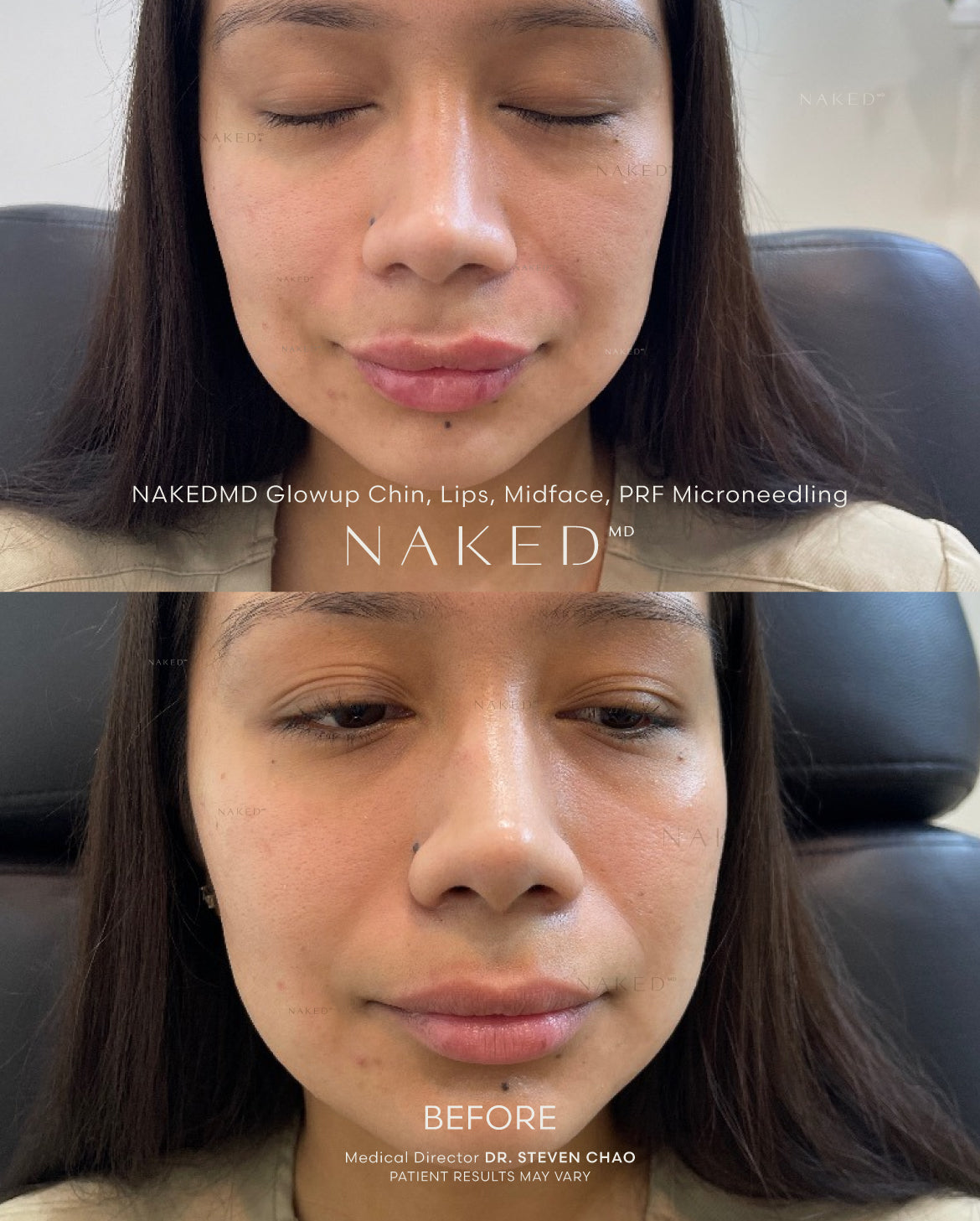 Naked Combo Lips | Chin