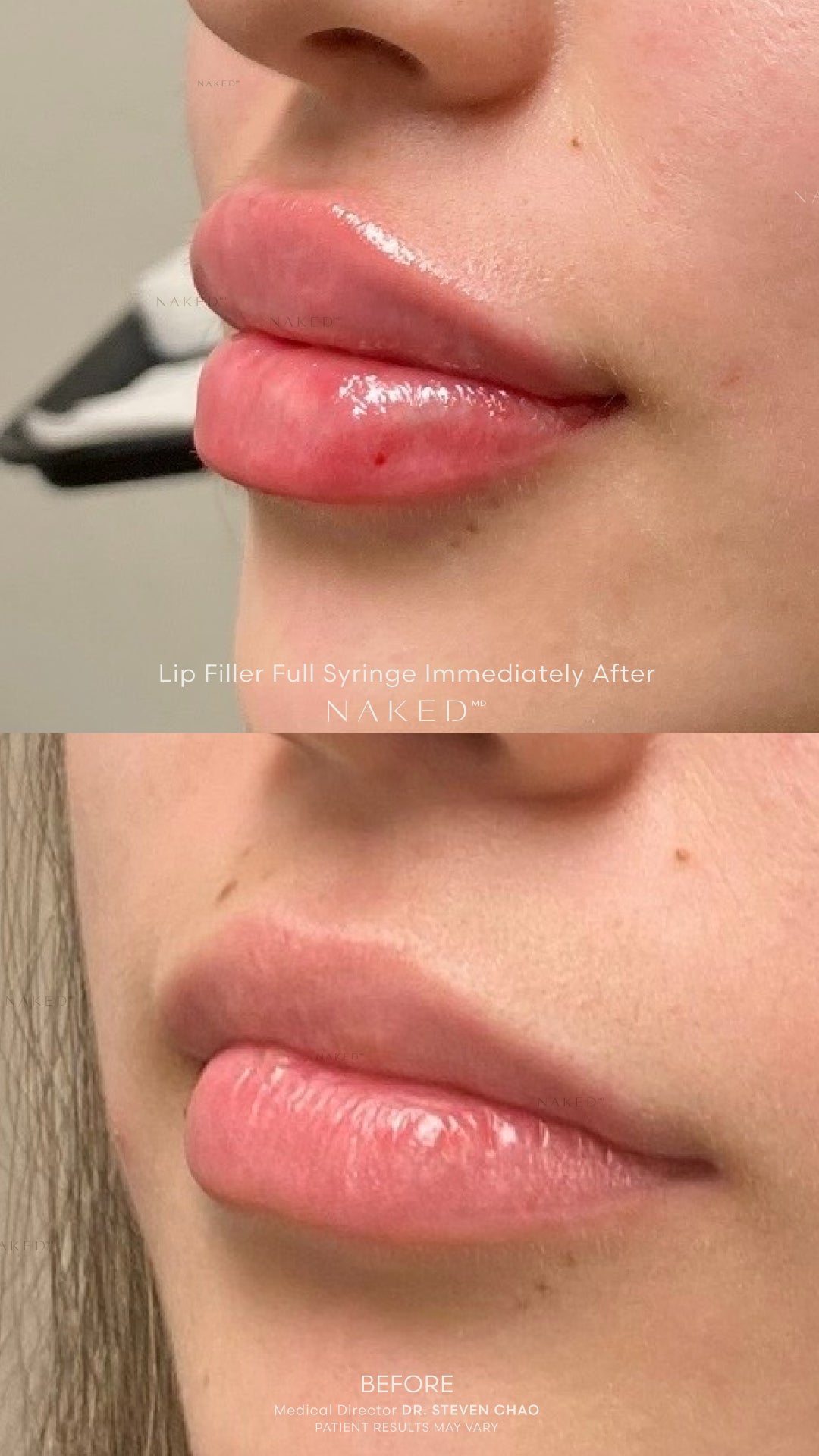 Naked Lips | Lip Filler